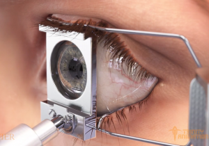 This is a 3D rendered image from one of Trinity's surgical animations displaying a medical tool holding eyelids open in preparation of a Lasik eye surgery procedure.