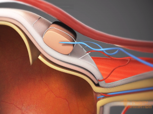 This still from the surgical animation displays extremely detailed close-up shots of the internal parts of the eye during a surgical procedure used to repair a retinal detachment.