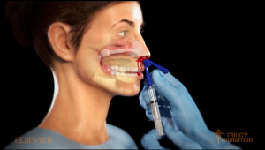 This image displays a 3D rendered image from the medical animation during an Epistaxis balloon devise inflation procedure. It is displaying a profile view of the figure and displaying internal organs of the head so the viewer can understand what the procedure accomplishes.