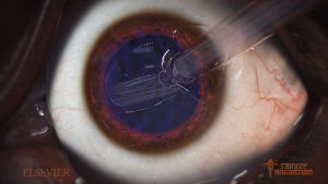 This is a close up image of the human eye rendered in trinity's 3D software displays the level of detail and realism that Trinity animators are able to reach in there surgical animations. This one demonstrates a cataract removal and lens replacement.