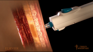 This 3D rendered image is displaying a medical tool called a jet-injector injecting into a humans body. The skin which it is injecting into is displayed in layers to inform the viewer exactly how it works.