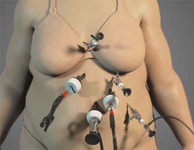 Full body rendering, displaying laparoscopic procedure underway.