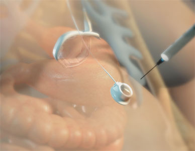 View of installed apparatus, allowing injection directly into the digestive tract.
