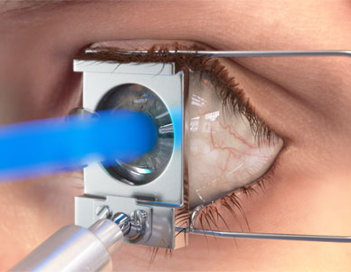 LASIK laser firing into the pupil of a human eye, correcting vision.