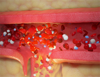 Cross section of vein showing puncture and blood cells pouring out.